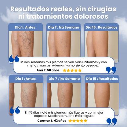 VARIVEINS™ - RECUPERA TUS PIERNAS ESTE VERANO